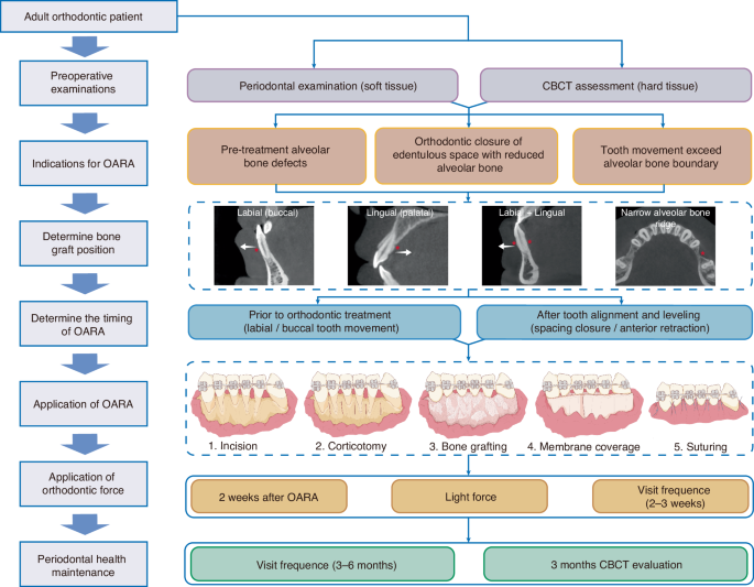Expert consensus on orthodontic-associated alveolar ridge augmentation for adult patients