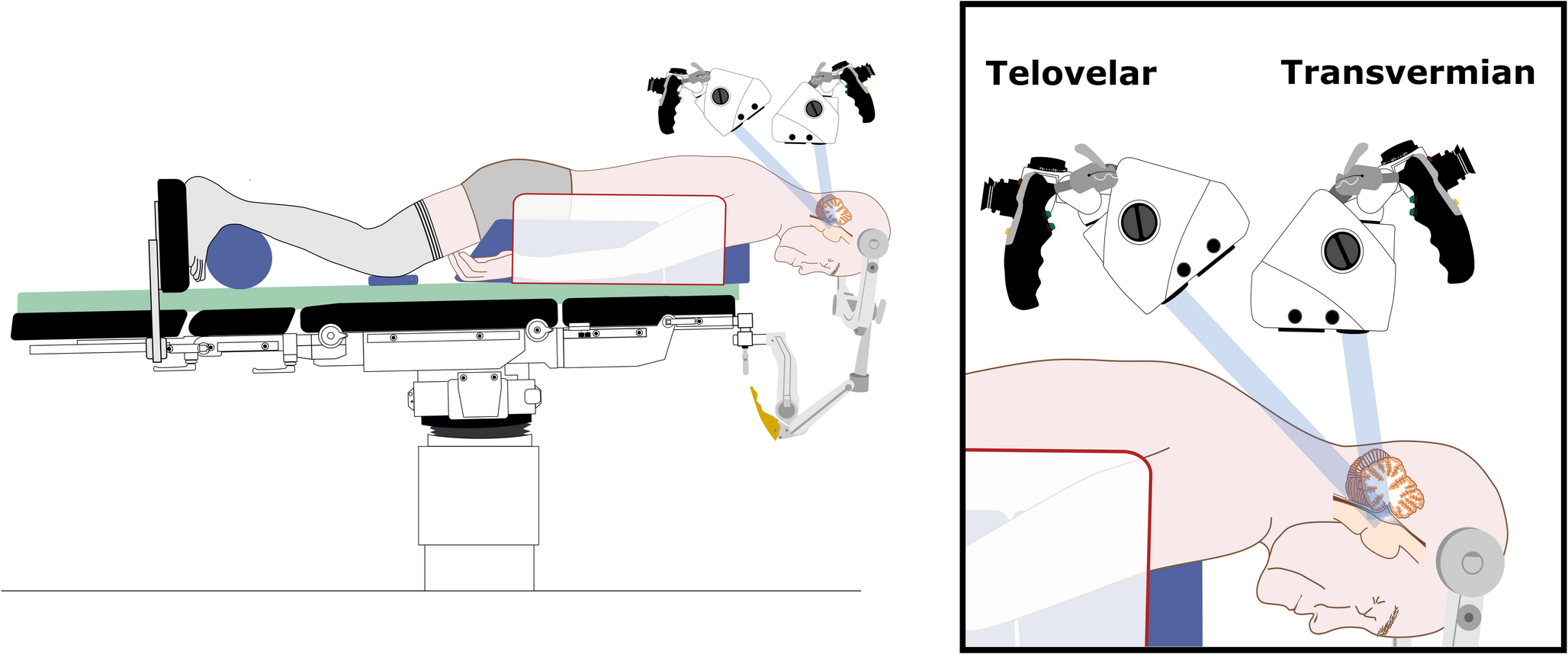 Neuroendoscopy improves operability and reduces hazardous vermian manipulation during the telovelar approach to the fourth ventricle’s floor: an anatomical study