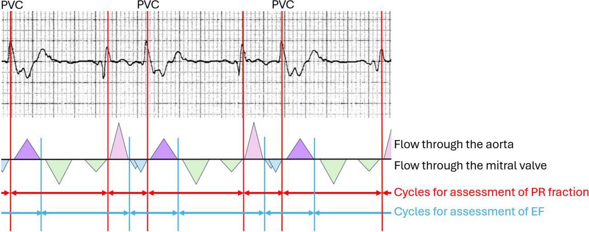 Cardiac MRI with metric optimized gating in pediatric patients with ventricular bigeminy