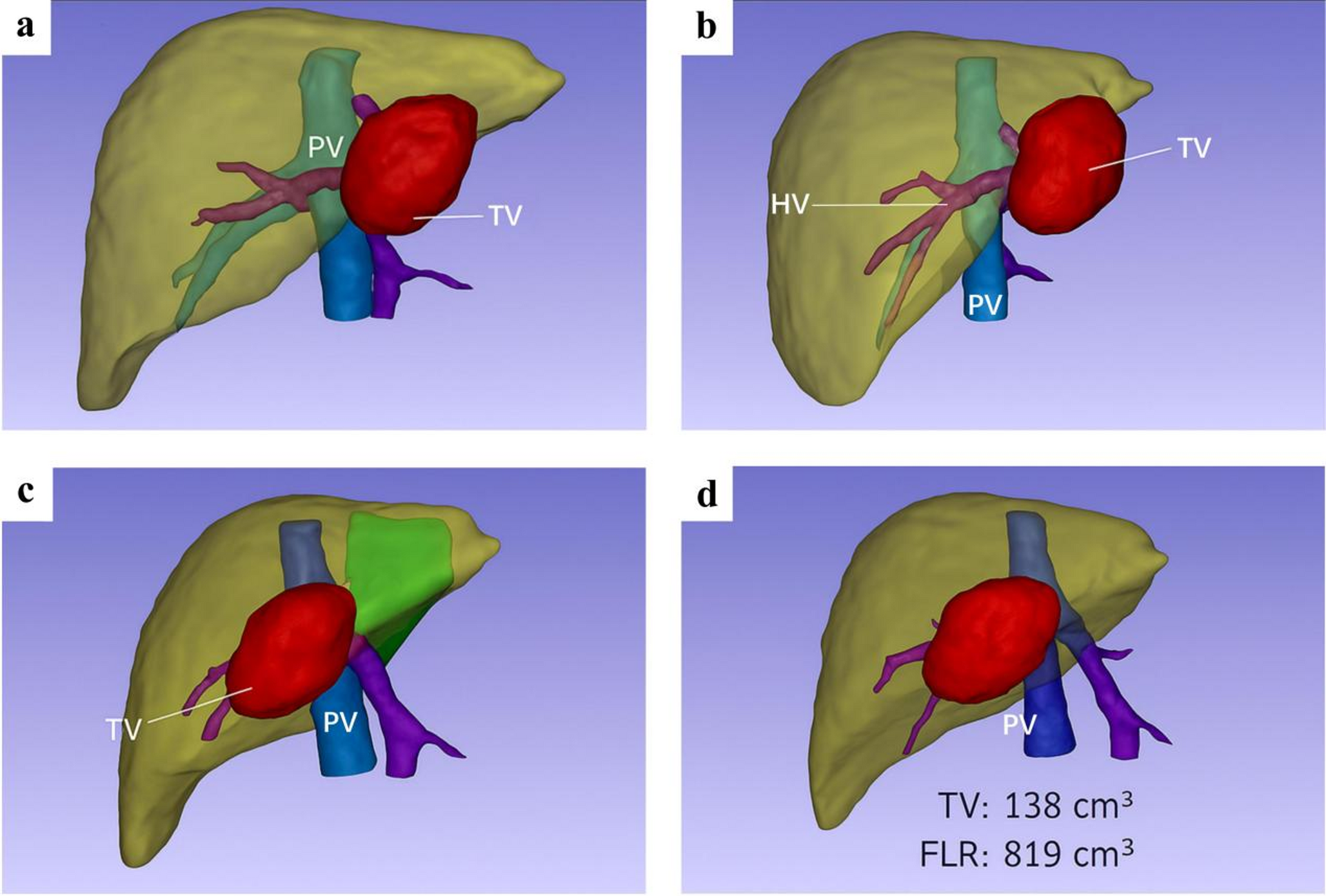 Fluorescence-guided laparoscopic hepatectomy with patient-specific 3D virtual reconstruction for pediatric focal nodular hyperplasia: a retrospective study