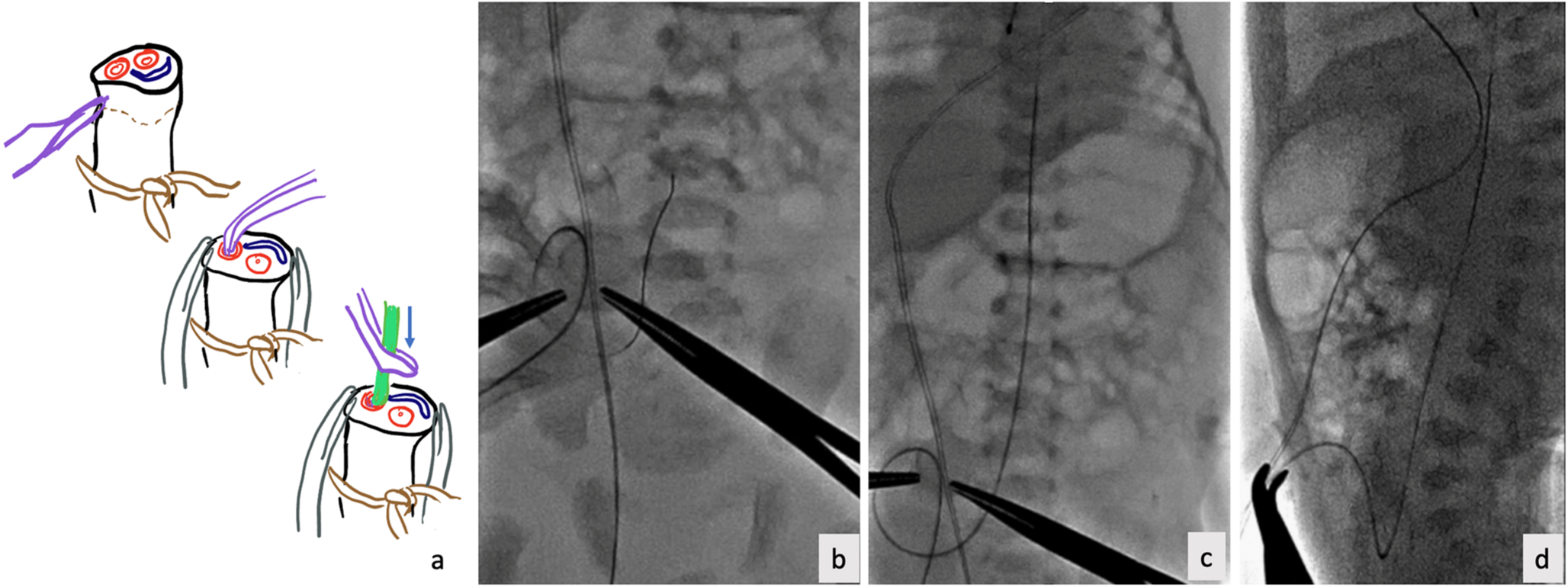 Umbilical Artery Access for PDA Stenting: Feasibility in Select Anatomy