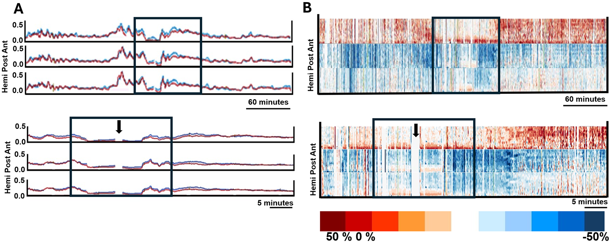 Quantitative Electroencephalogram Patterns During Neonatal Antegrade Cerebral Perfusion and Deep Hypothermic Circulatory Arrest that Suggest Neurologic Injury