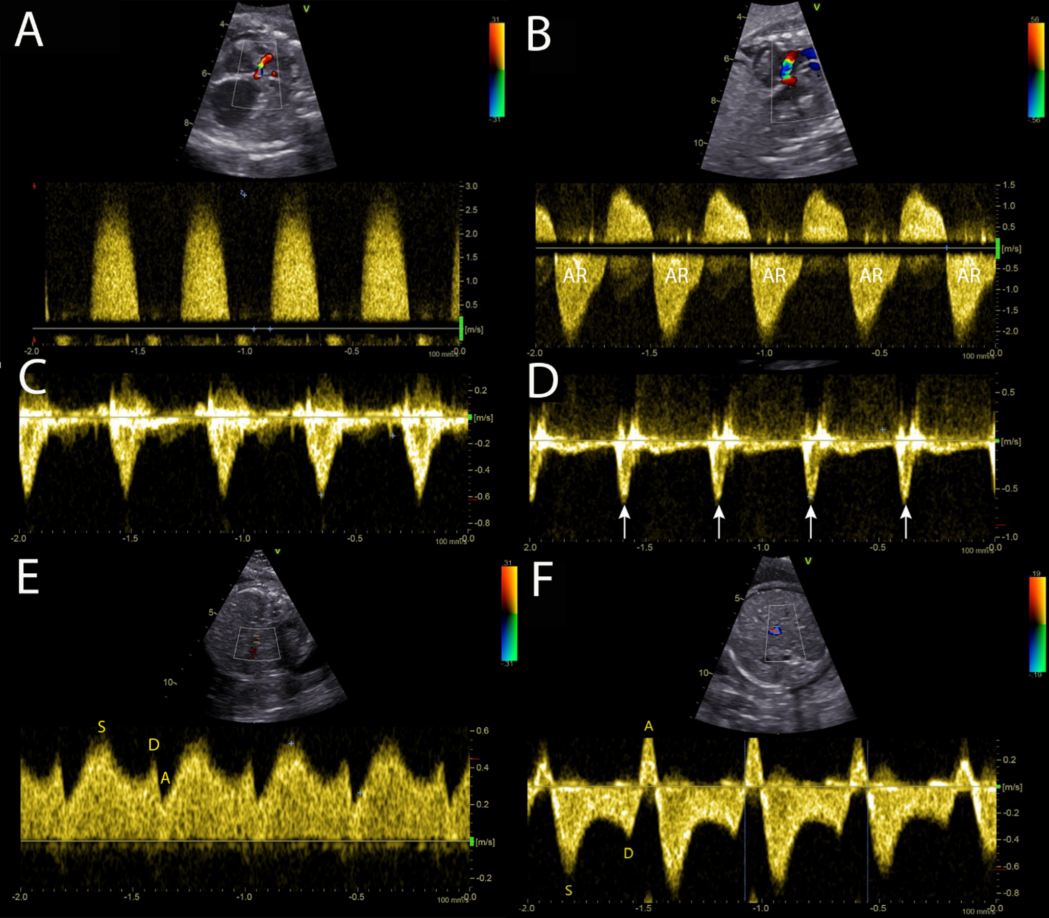 Severe Aortic Regurgitation with New Congestive Heart Failure Following Fetal Aortic Valvuloplasty – A Case Report