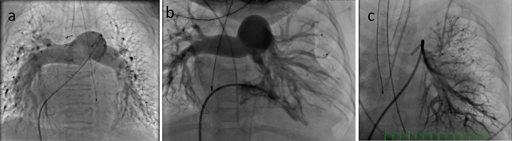 Pulmonary Hypertension in Pediatric Patients with Noonan Syndrome Undergoing Cardiac Catheterization
