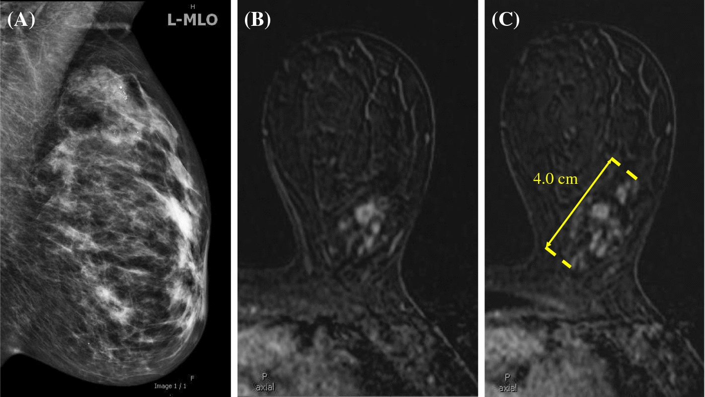I﻿s Neoadjuvant Chemotherapy Justified When Triple-Negative Breast Cancer or HER2-Positive Breast Cancer Presents as ≥1 cm of Only Calcifications or as a Subcentimeter Mass with Surrounding Calcification﻿s?