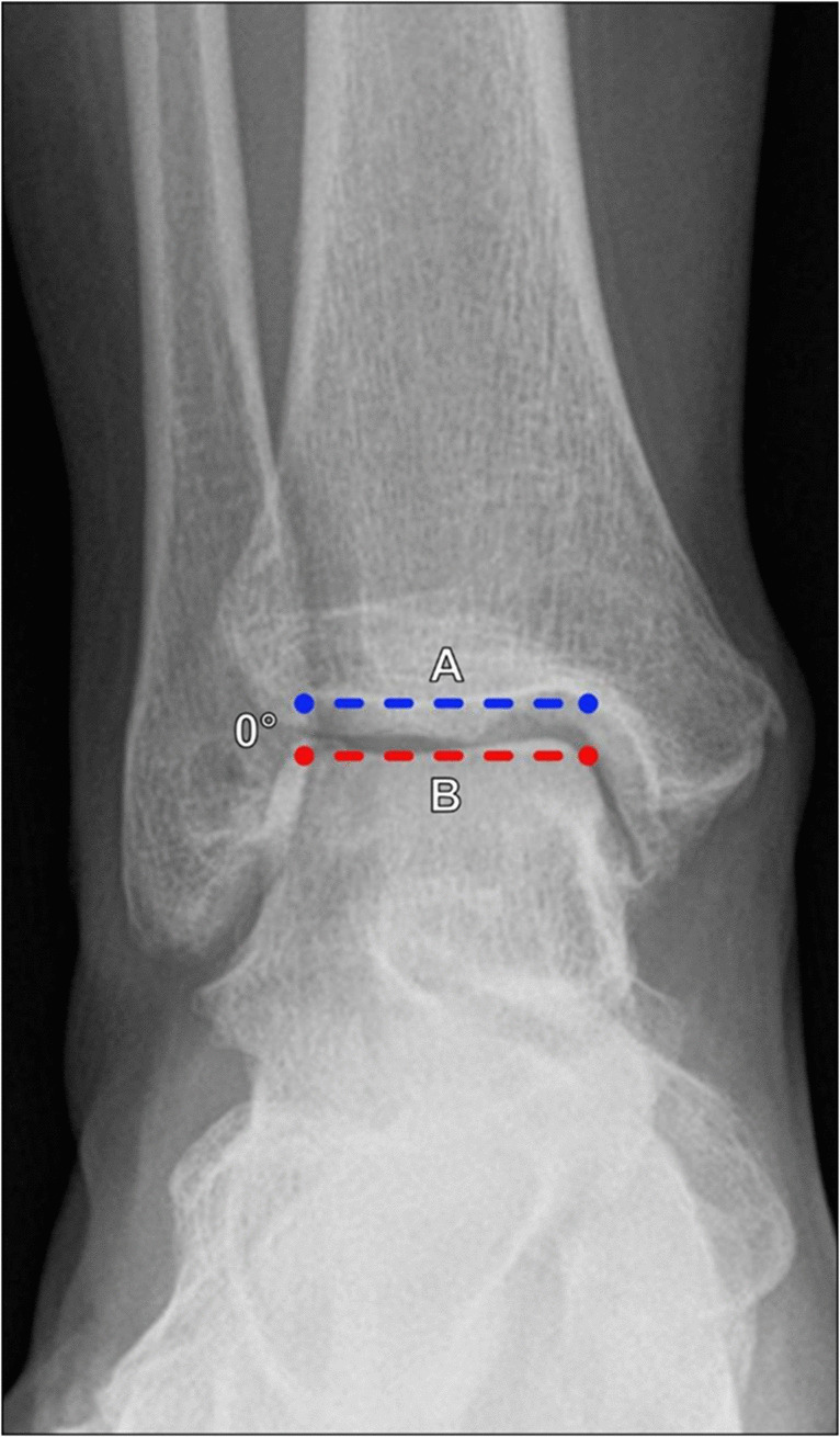 Guide to lower extremity radiologic measurements: part 3 ankle and foot