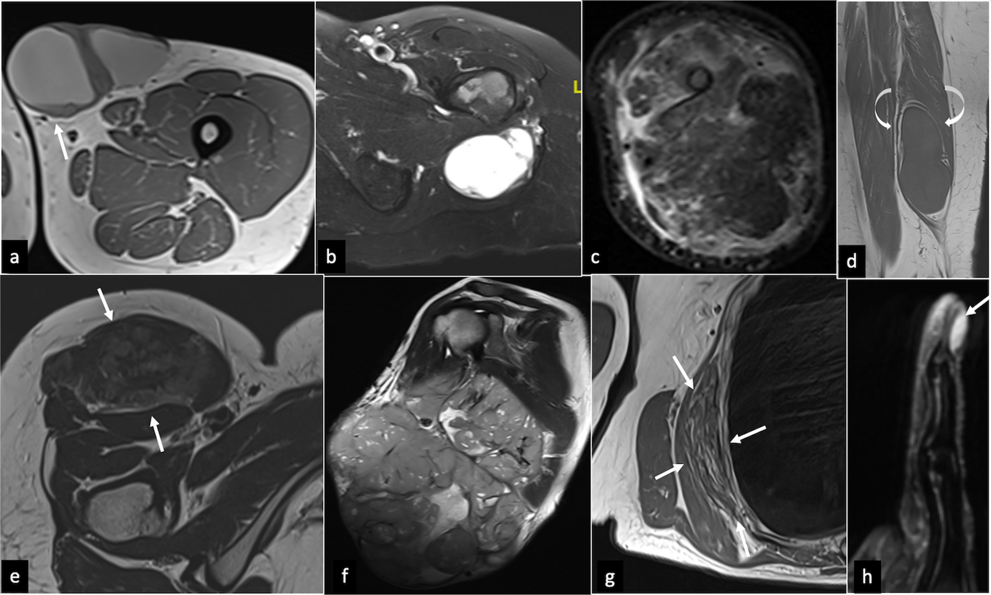MRI of soft tissue tumours: a structured “8S framework” aligned with WHO 2020 classification