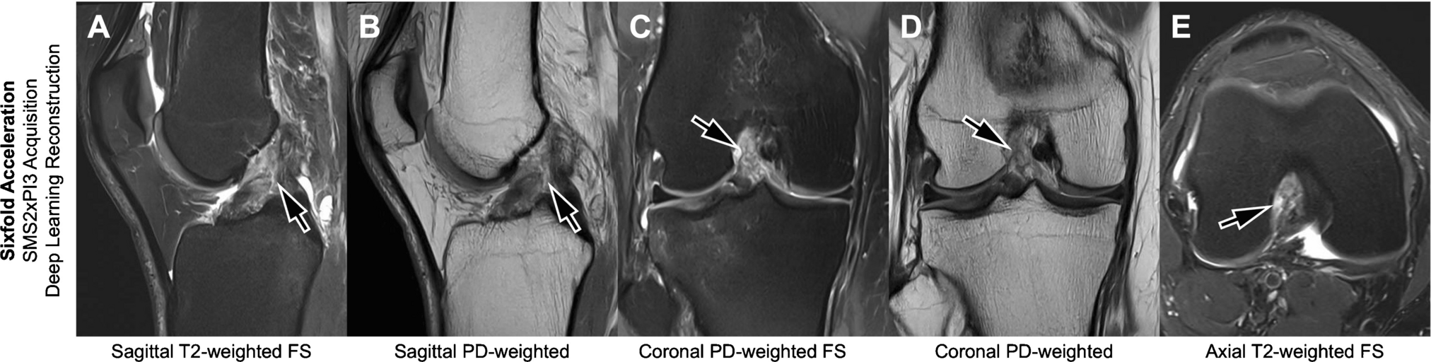 Best fast MRI protocols for the knee: advantages and limitations