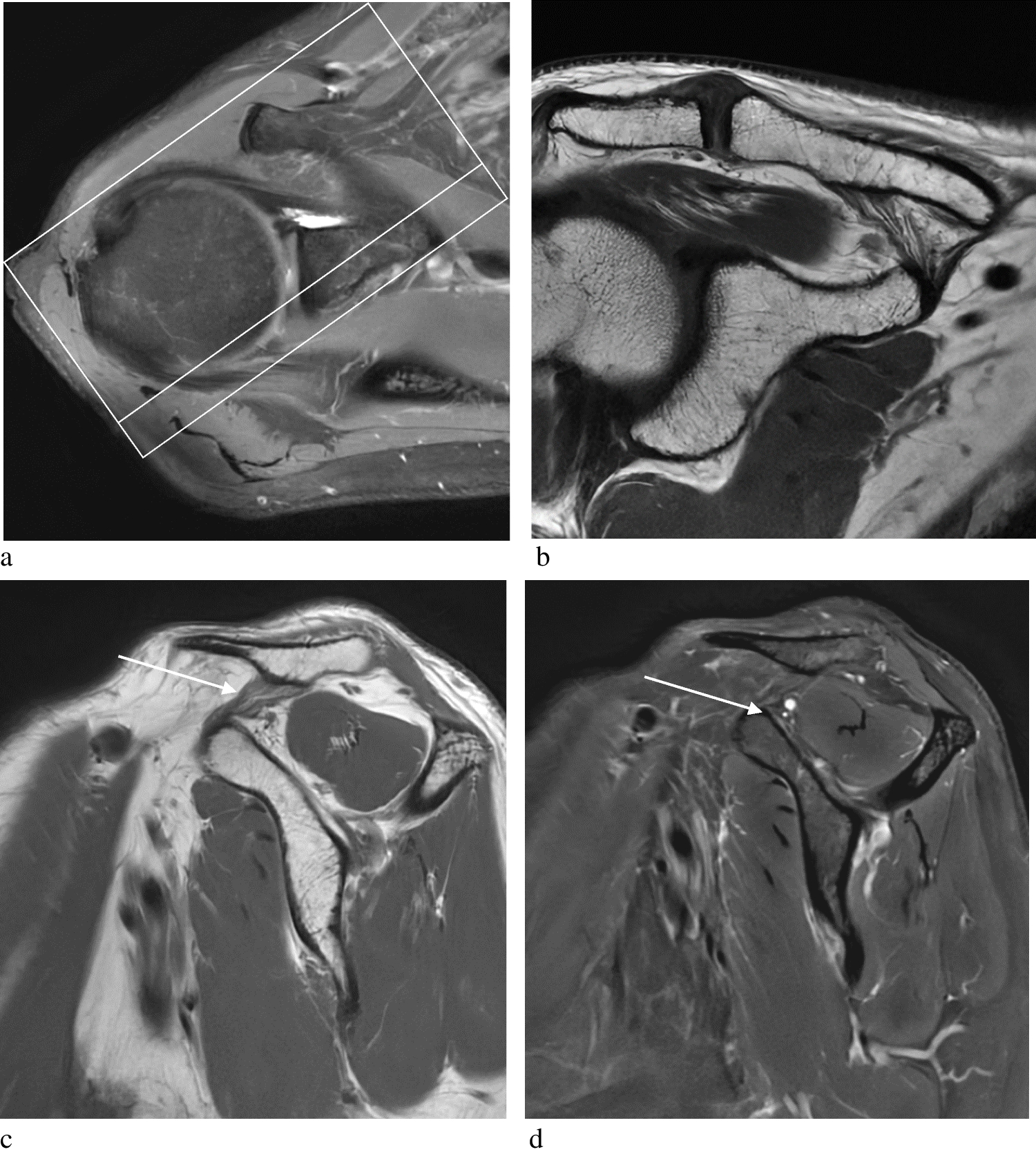 Assessment of dedicated MRI sequences in the evaluation of the acromioclavicular joint dislocation—A retrospective study