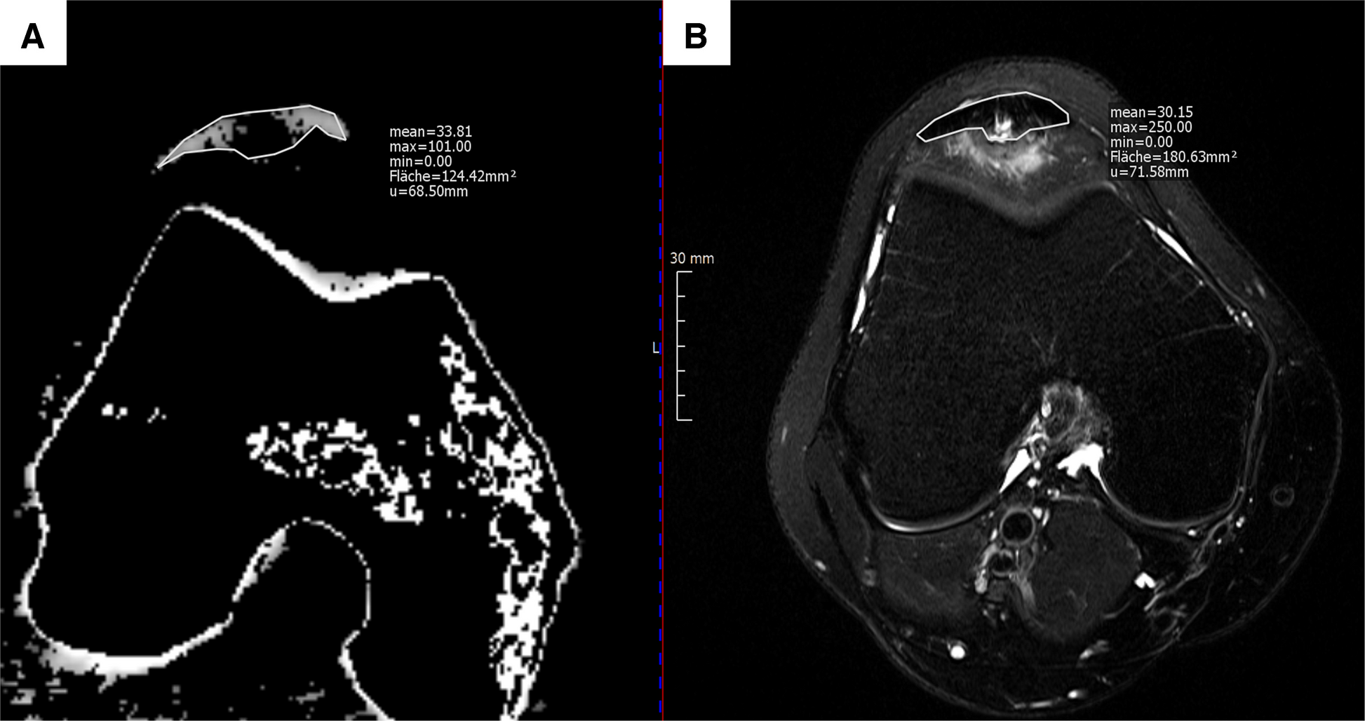 Collagen-sensitive dual-energy-CT as a quantitative tool for tendinopathy assessment: a prospective diagnostic accuracy study