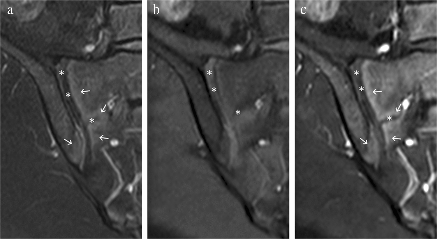 The immature sacroiliac joints on cross-sectional imaging: developmental anatomy and diagnostic pitfalls