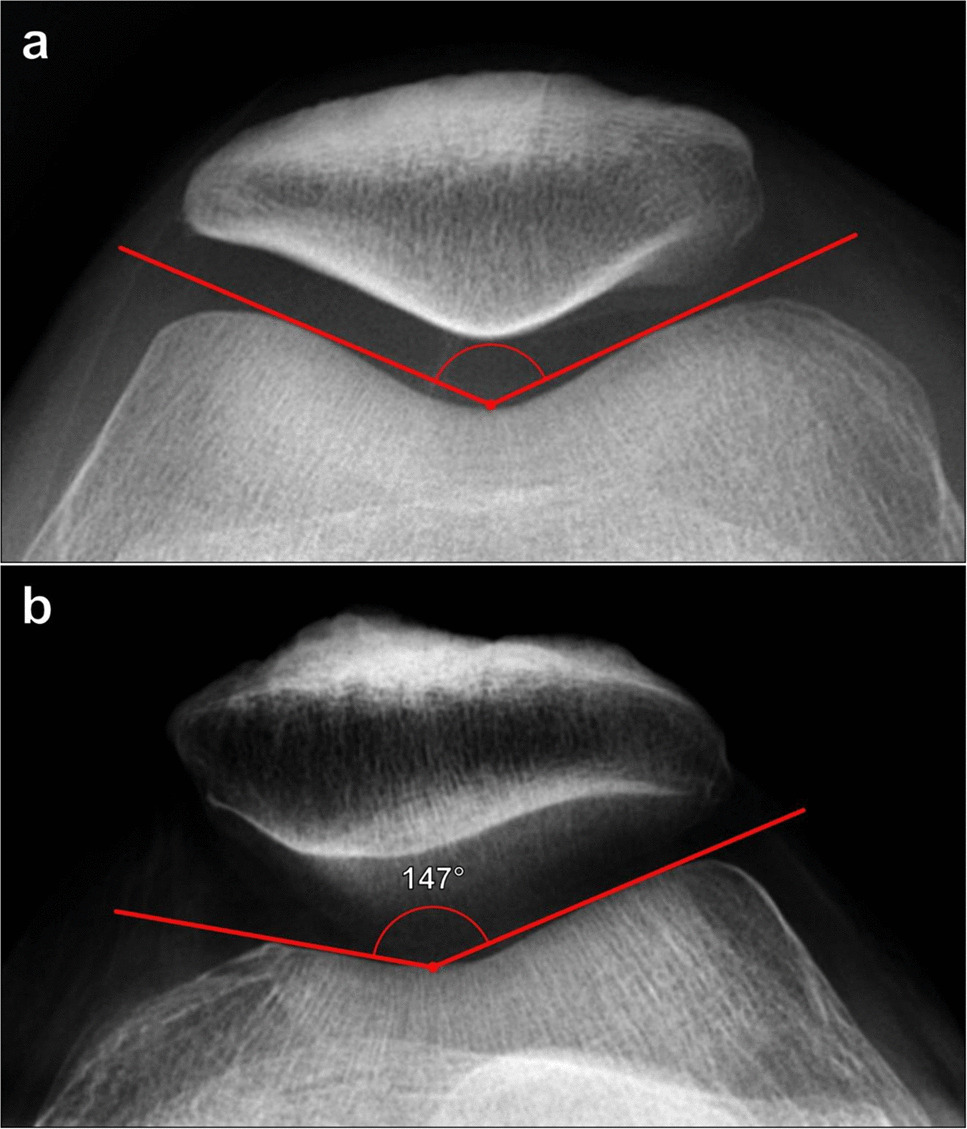 Guide to lower extremity radiologic measurements: part 2 knee