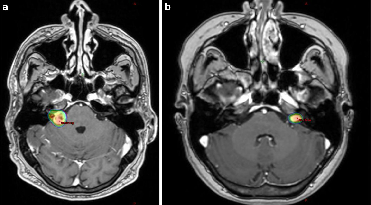 Comparative analysis of different modalities of radiotherapy in vestibular schwannoma: tumor control, symptom evolution, and toxicity profiles