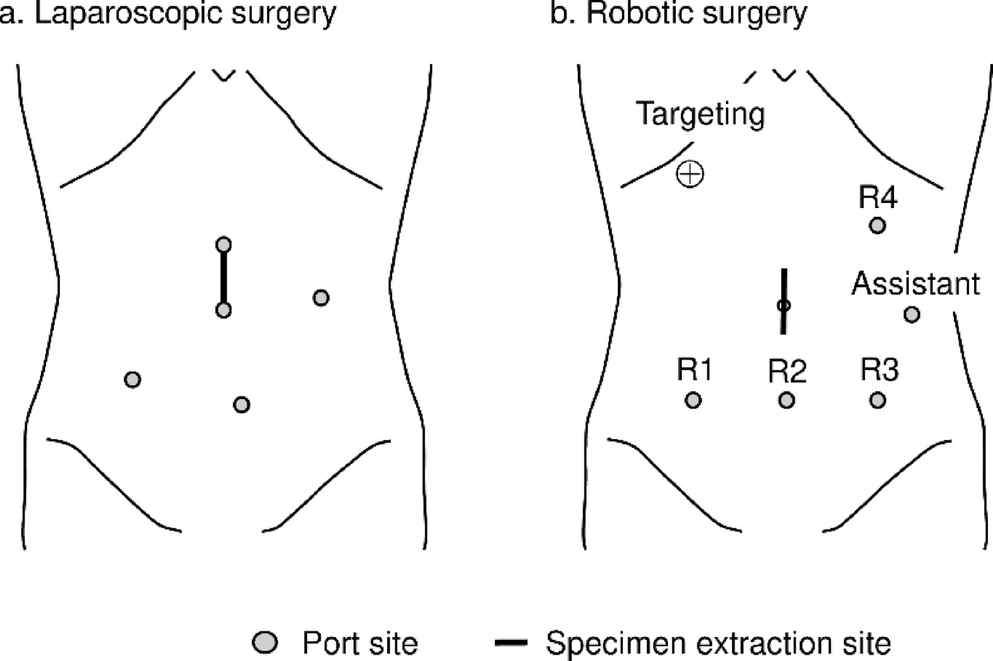 Factors influencing surgical difficulty in minimally invasive right hemicolectomy