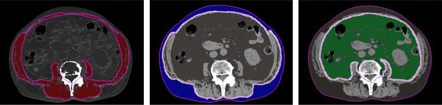 Subcutaneous adipose tissue loss as an early indicator of cancer cachexia in unresectable pancreatic cancer