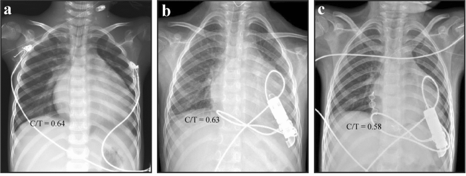 Jarvik 2015 ventricular assist device in a child with dilated cardiomyopathy and end-stage heart failure