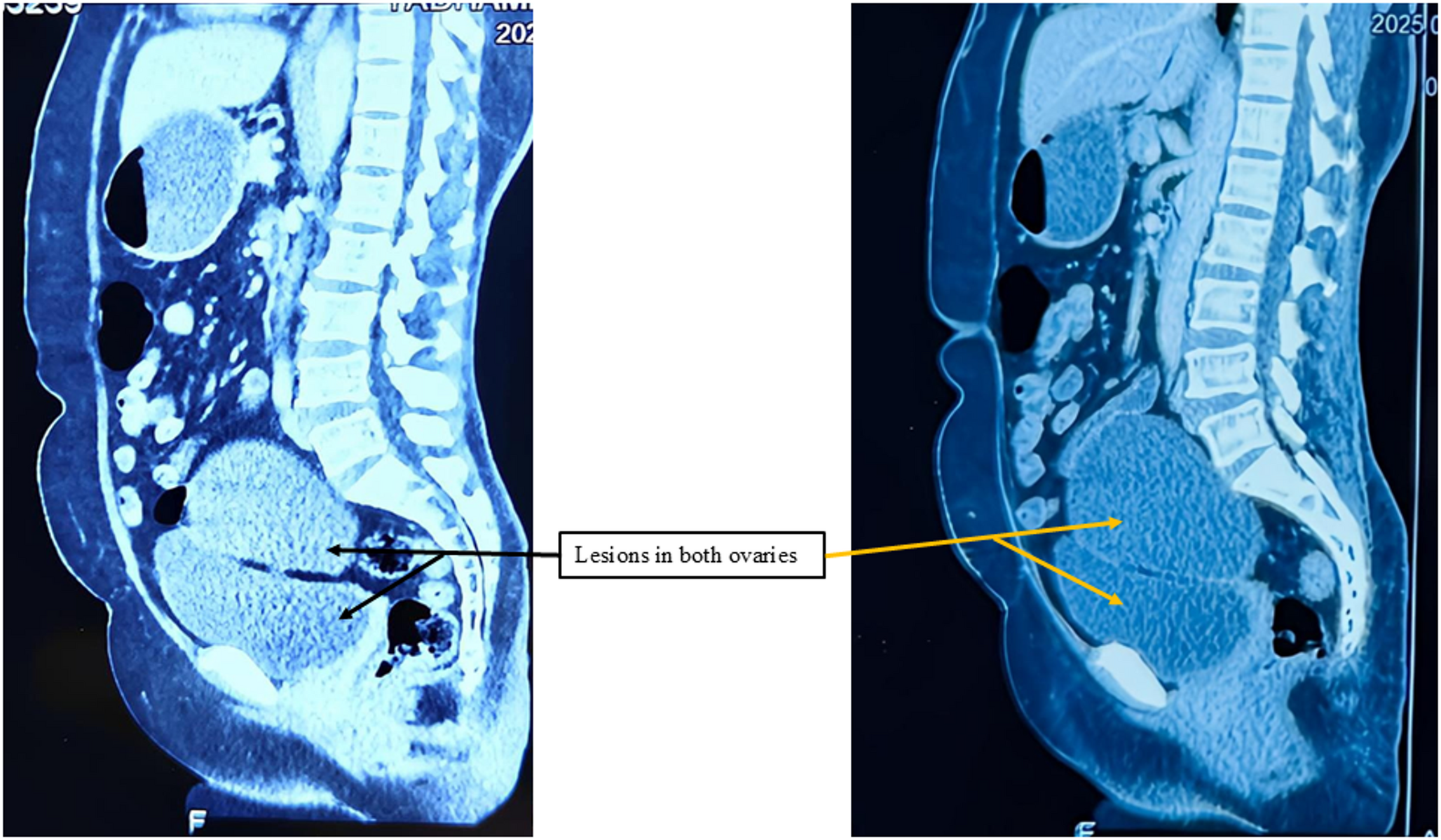 Triple Pathology in a Post-hysterectomized Woman: STIC, Borderline Serous Ovarian Tumor, and Benign Mucinous Cystadenoma: A Case Report and Review of Literature