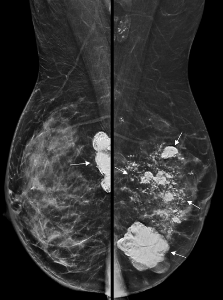 High Grade Serous Ovarian Carcinoma with Breast and Peritoneal Metastases