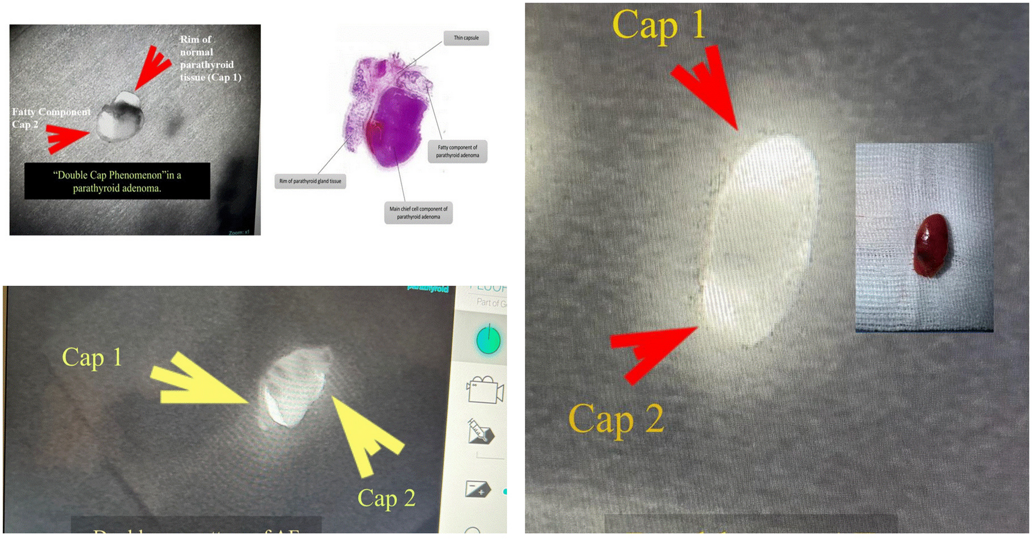 The double cap pattern of autofluorescence validated as a pathognomonic pattern of autofluorescence on near infrared autofluorescence (NIRAF) imaging for parathyroid adenomas