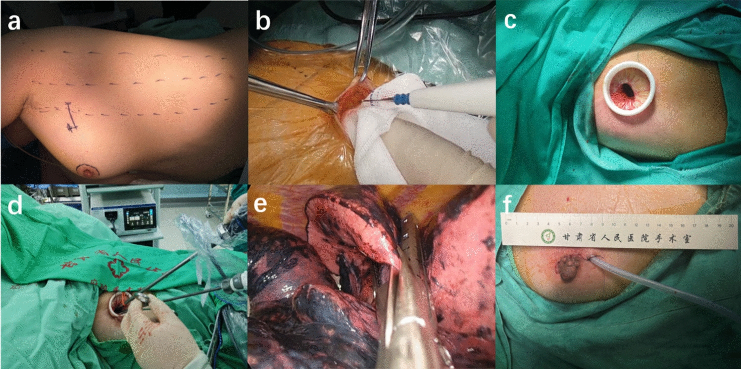 Analysis of the safety and feasibility of subcutaneous areolar tunnel single-port thoracoscopic radical resection for lung cancer: a retrospective cohort study