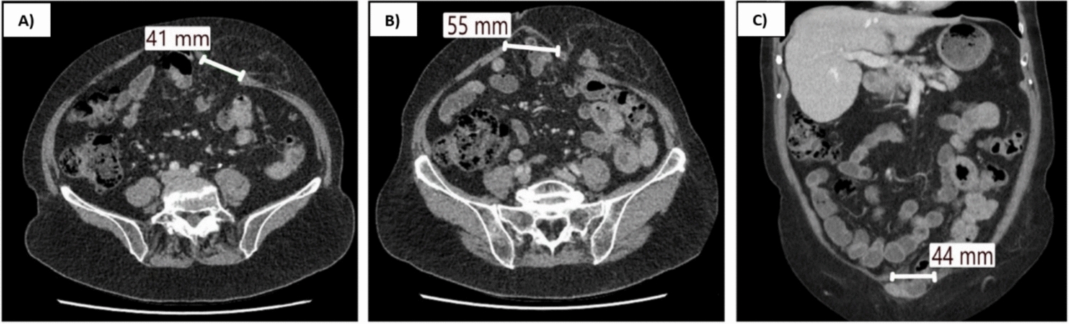 Modified preperitoneal endoscopic pauli (Pe-Pauli) approach for concomitant repair of parastomal and midline hernias