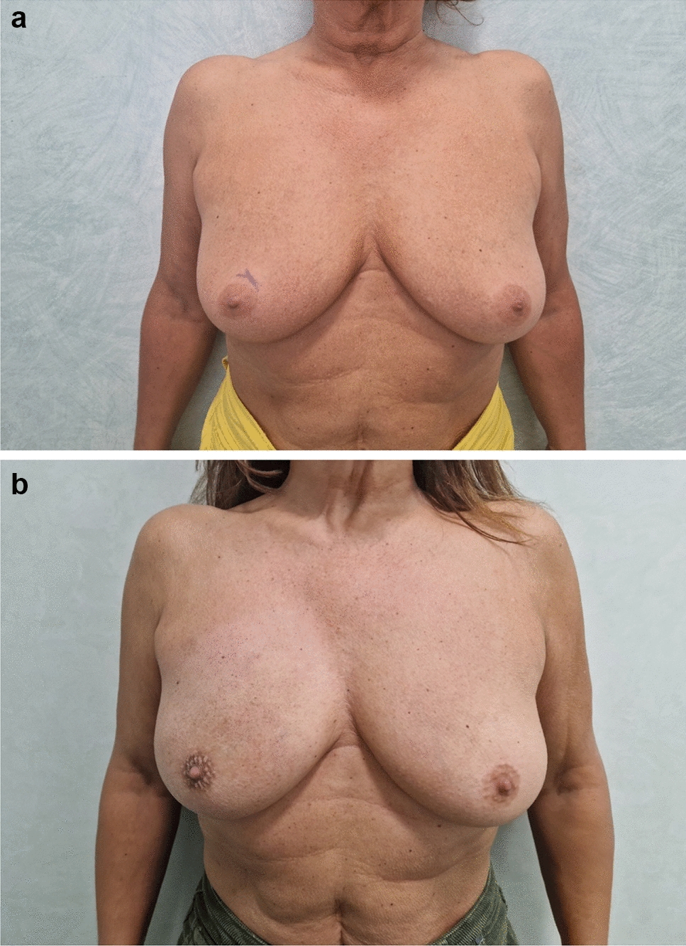 Safety of the use of an absorbable implant in breast-conserving surgery followed by radiotherapy: preplanned interim results from a prospective study