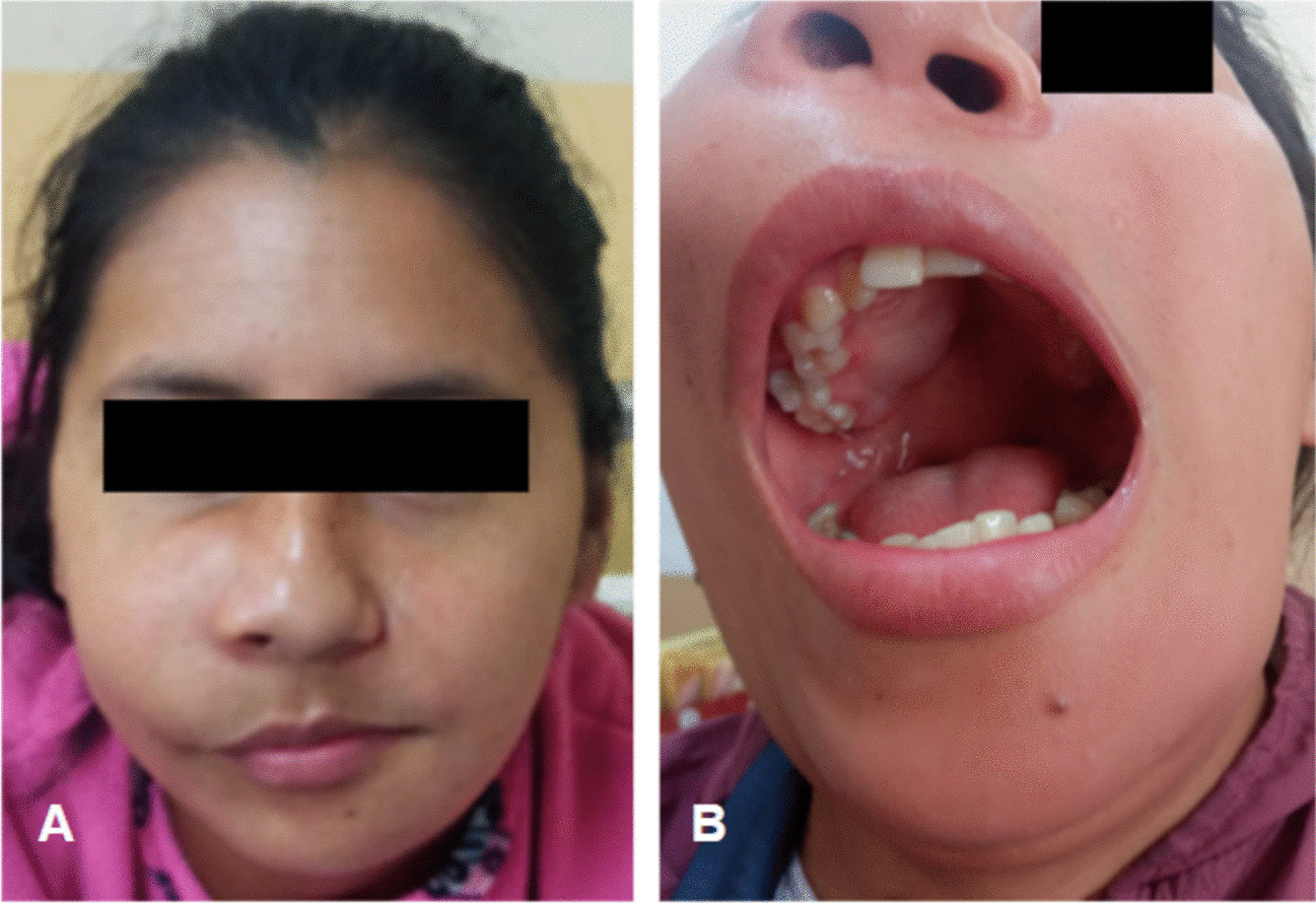 Primary Hyperparathyroidism-Jaw Tumor Syndrome Associated with CDC73 Gene Mutation: A Case Report