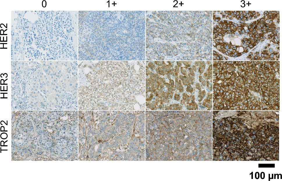 Expression of HER2, HER3, and TROP2 in primary tumors and brain metastases of breast cancer