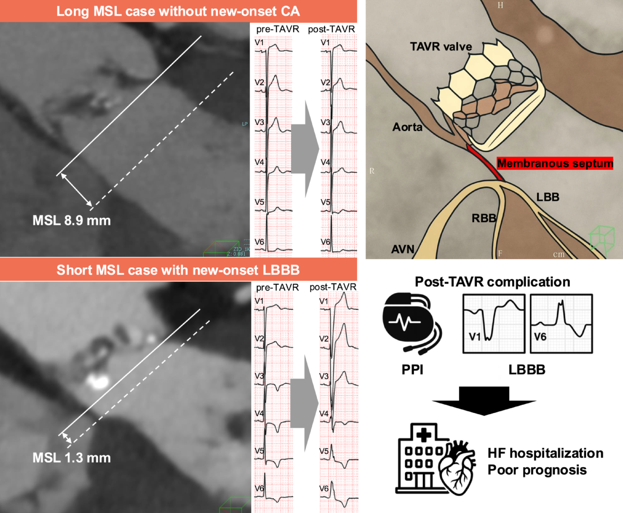 Impact of short membranous septal length on overall survival after transcatheter aortic valve replacement