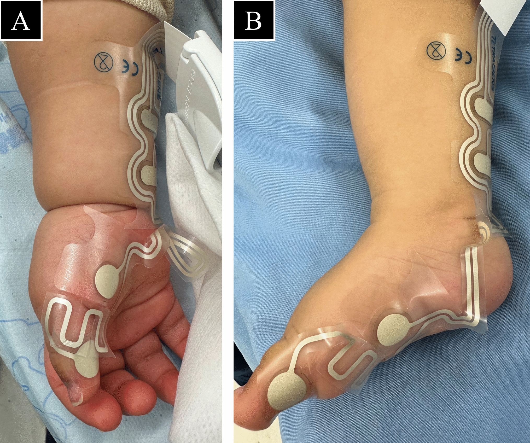 Comparison of electromyographic recovery from rocuronium-induced neuromuscular block between the adductor pollicis and the flexor hallucis brevis muscles in pediatric patients younger than two years