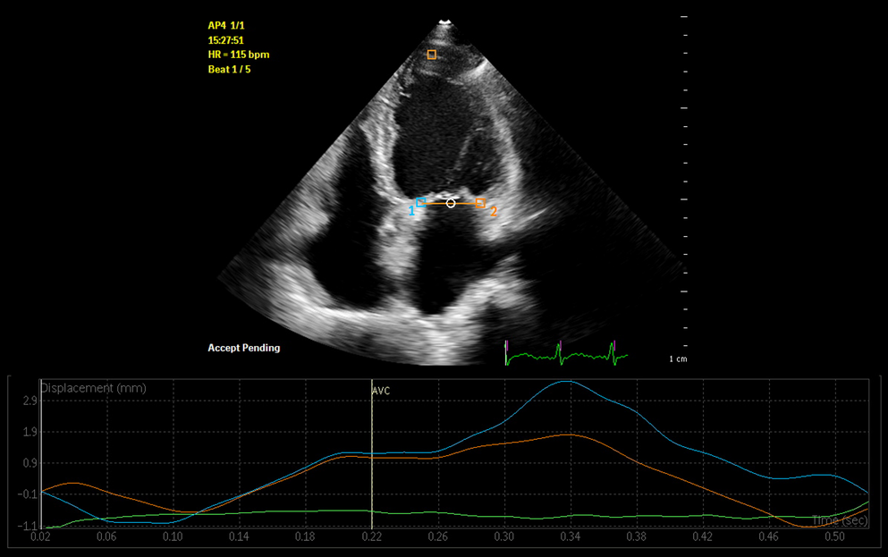 A TMAD-based rapid assessment model for left ventricular systolic function in patients with coronary artery disease: a multicenter prospective development and validation study