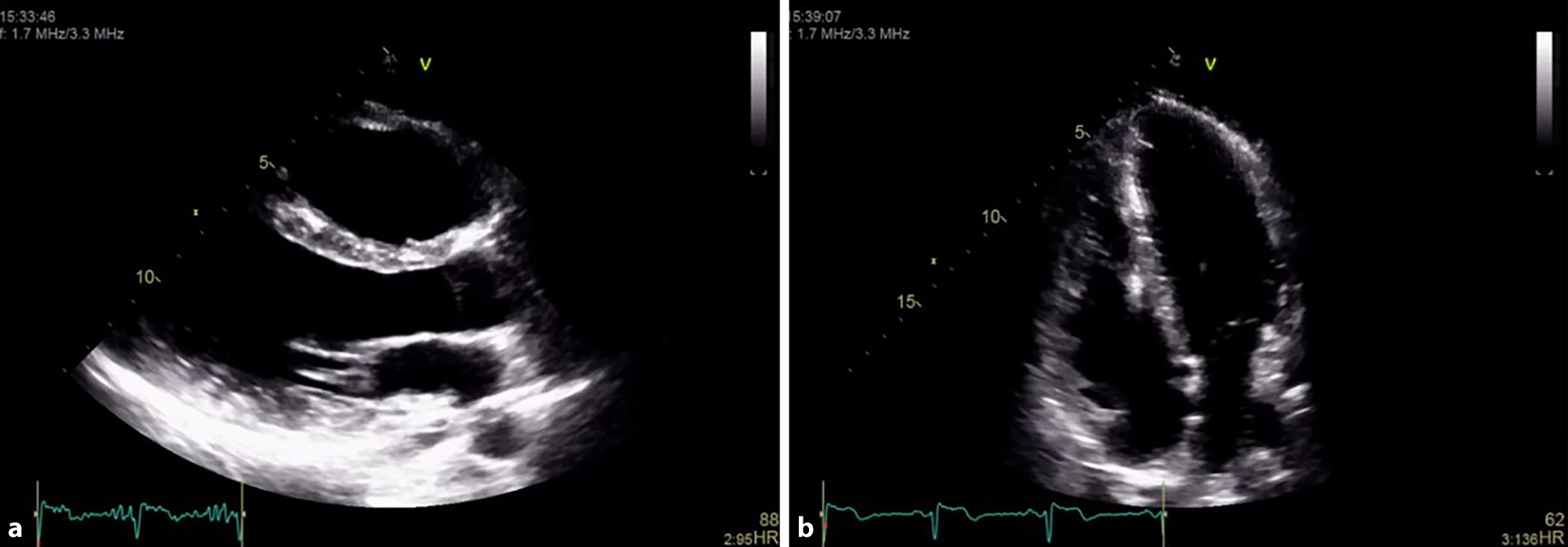 Exercise-induced ventricular tachycardia in a young adult: what lies beneath?