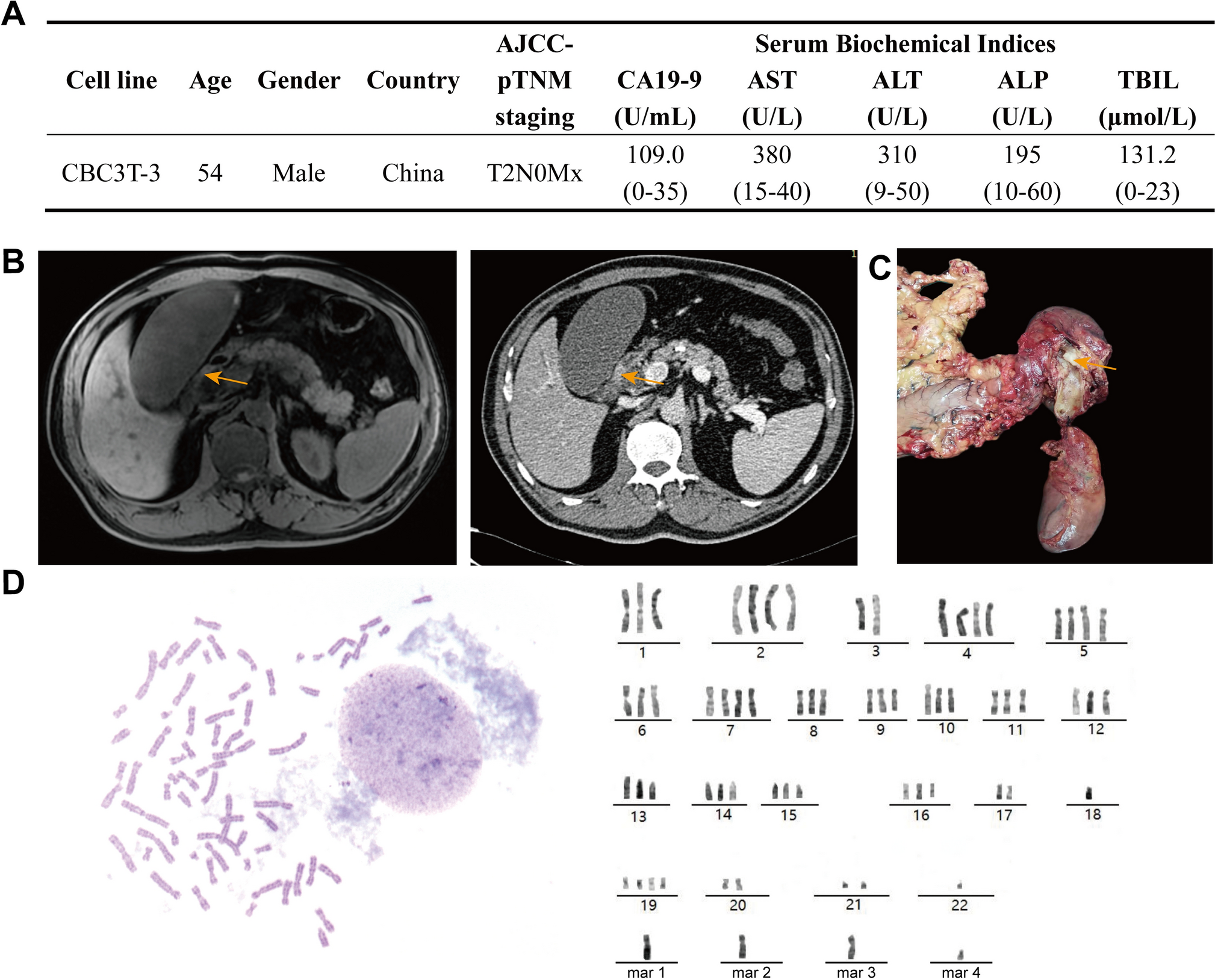CBC3T-3: a novel patient-derived cisplatin-resistant distal cholangiocarcinoma cell line harboring multiple  missense mutations