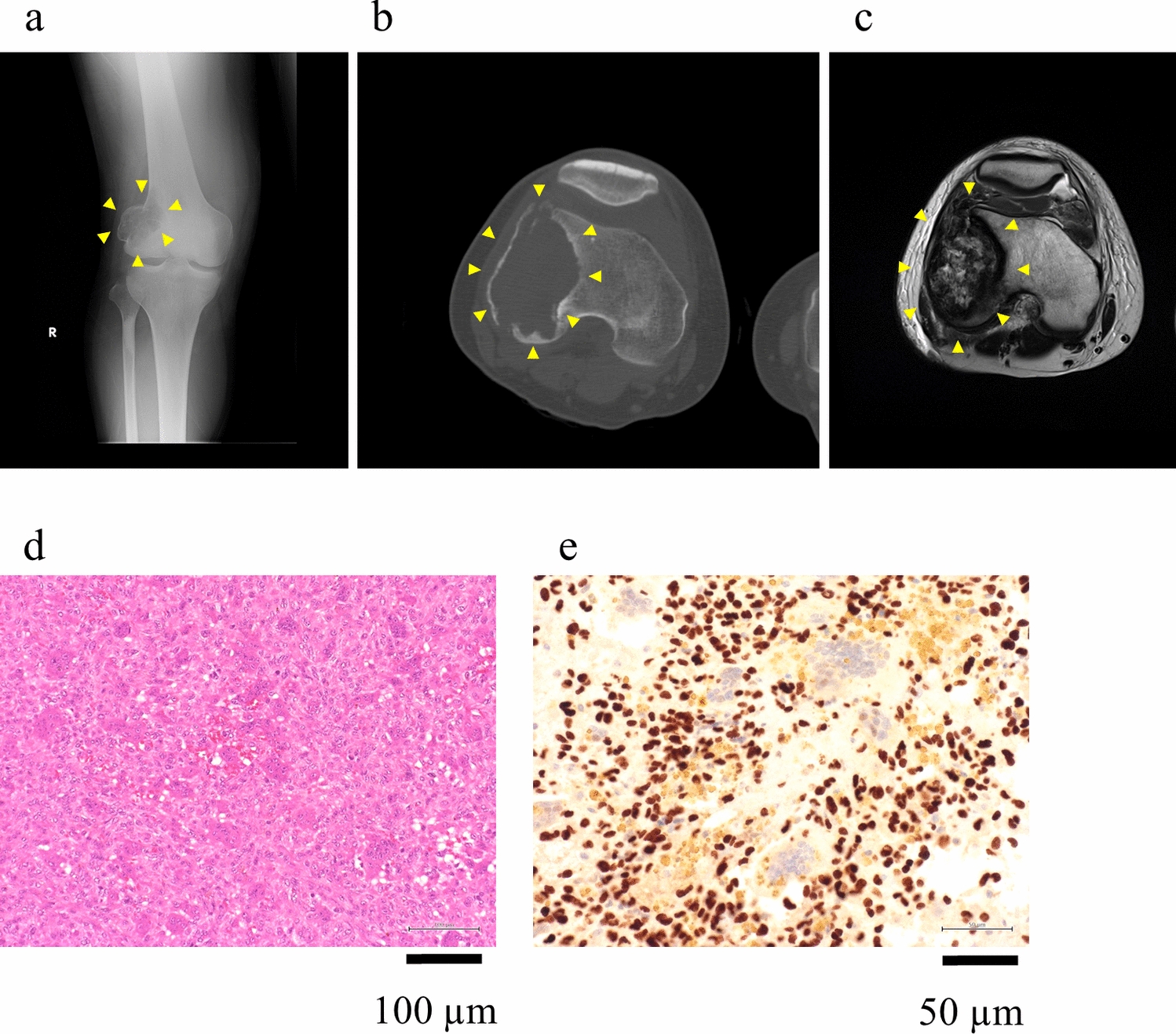 Establishment and characterization of NCC-GCTB16-C1: novel patient-derived cell line of giant cell tumor of bone