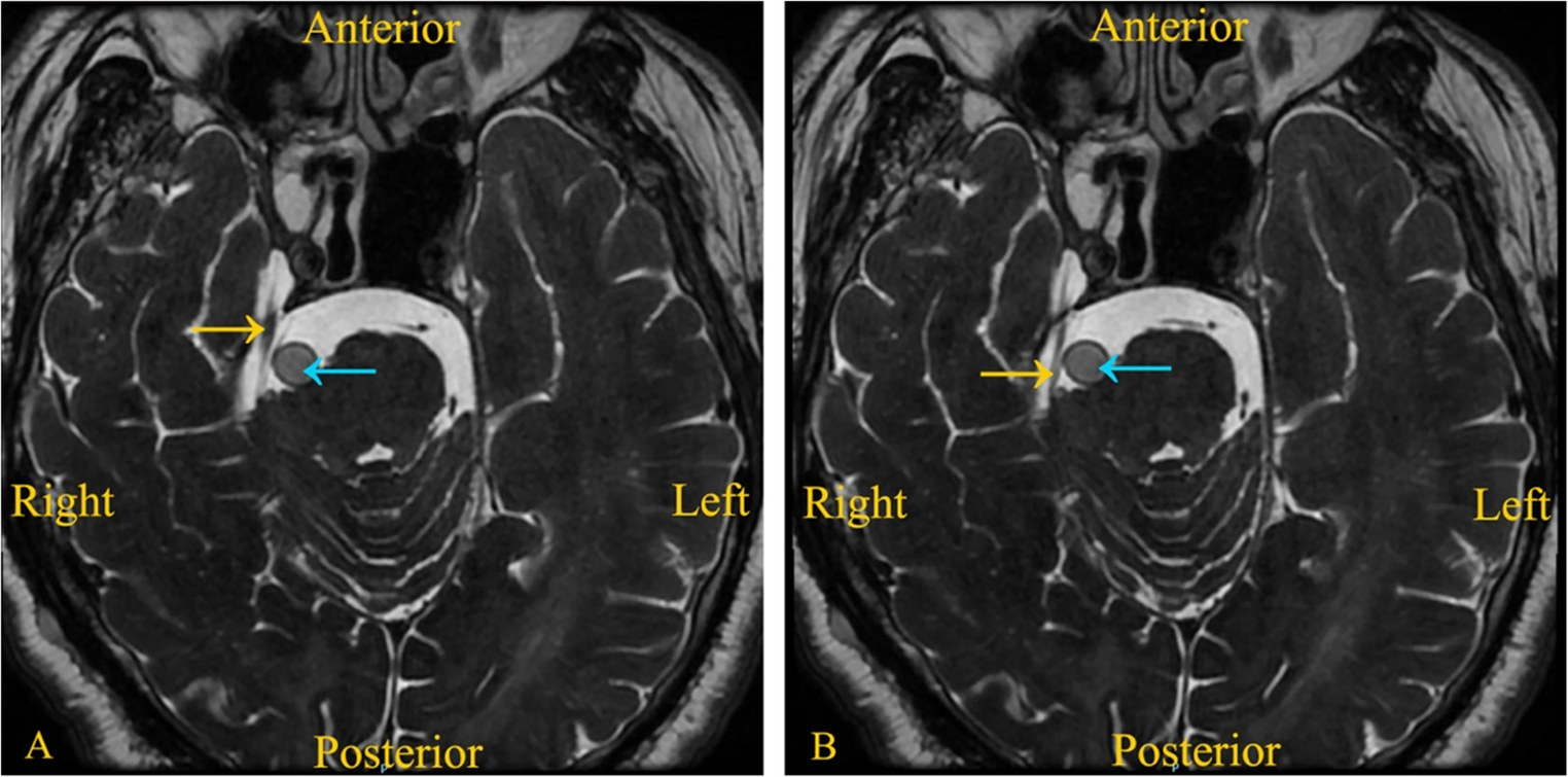 Pivotal Factors for Minimizing the Risks of Therapeutic Failure in Trigeminal Neuralgia and Hemifacial Spasm