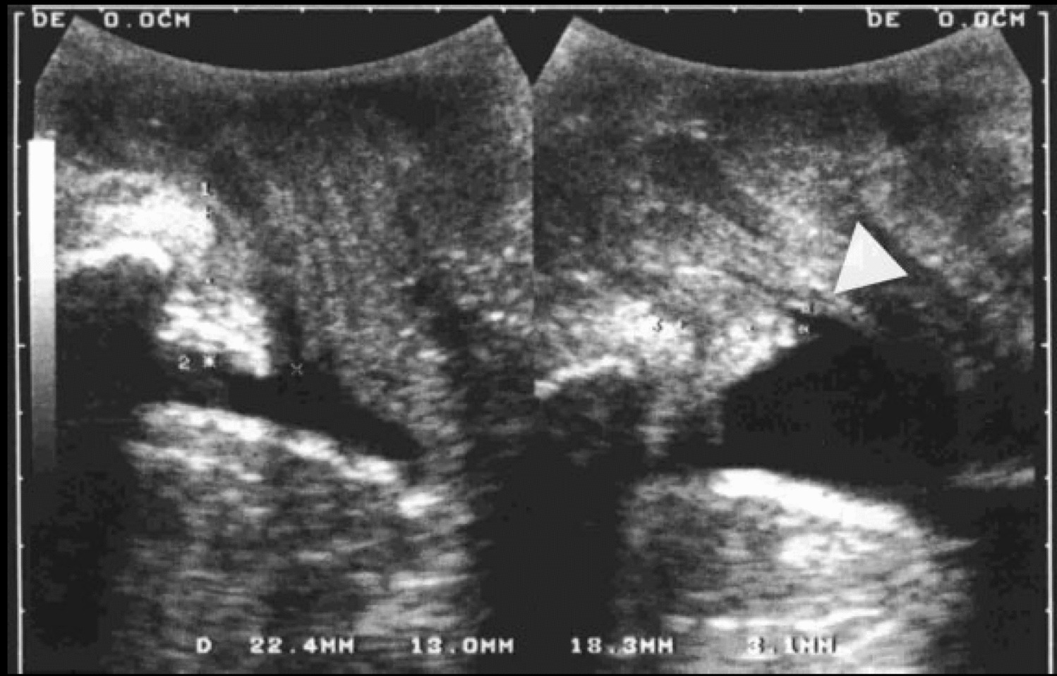 The Evolution of Pelvic Floor Ultrasound: From Urinary Incontinence and Pelvic Organ Prolapse to Maternal Birth Trauma, Levator Avulsion and Anal Sphincter Tears