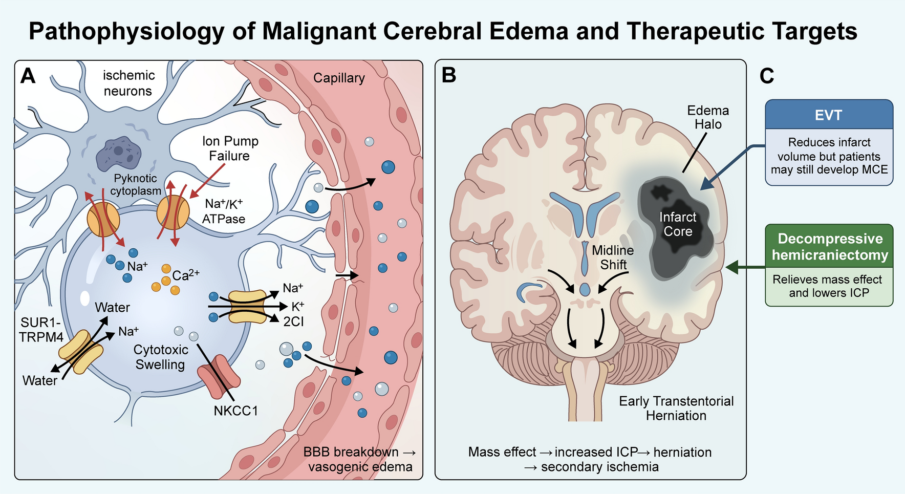 Malignant Cerebral Edema after Large-Core Anterior Circulation Stroke in the Thrombectomy Era: Prediction and Neurocritical Care Pathways