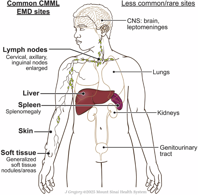 Chronic myelomonocytic leukemia beyond the marrow: biology, patterns, and management of extramedullary disease