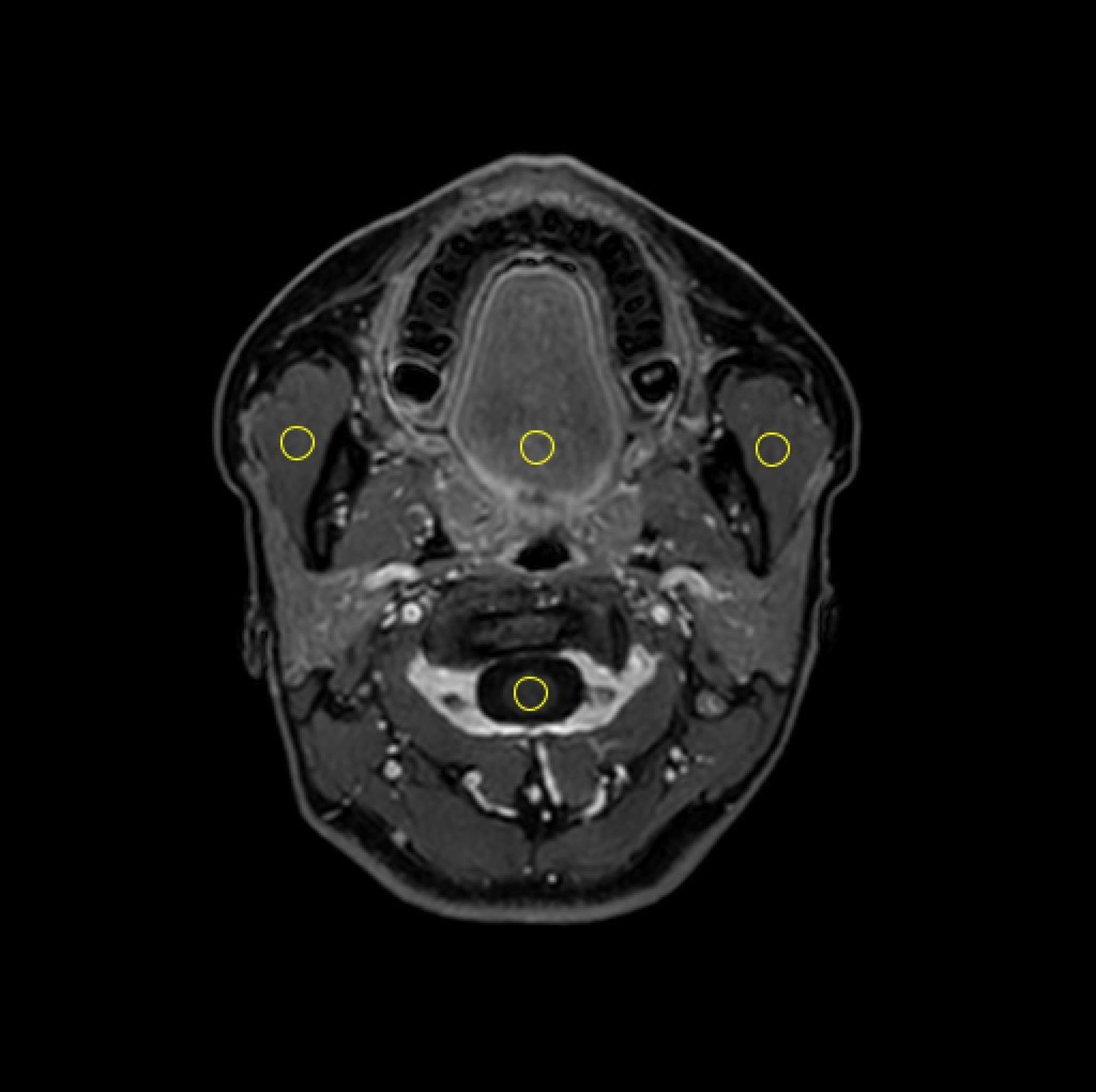 The effect of deep learning-based compressed sensing on the image quality of contrast-enhanced 3D T1-weighted images of the maxillofacial region