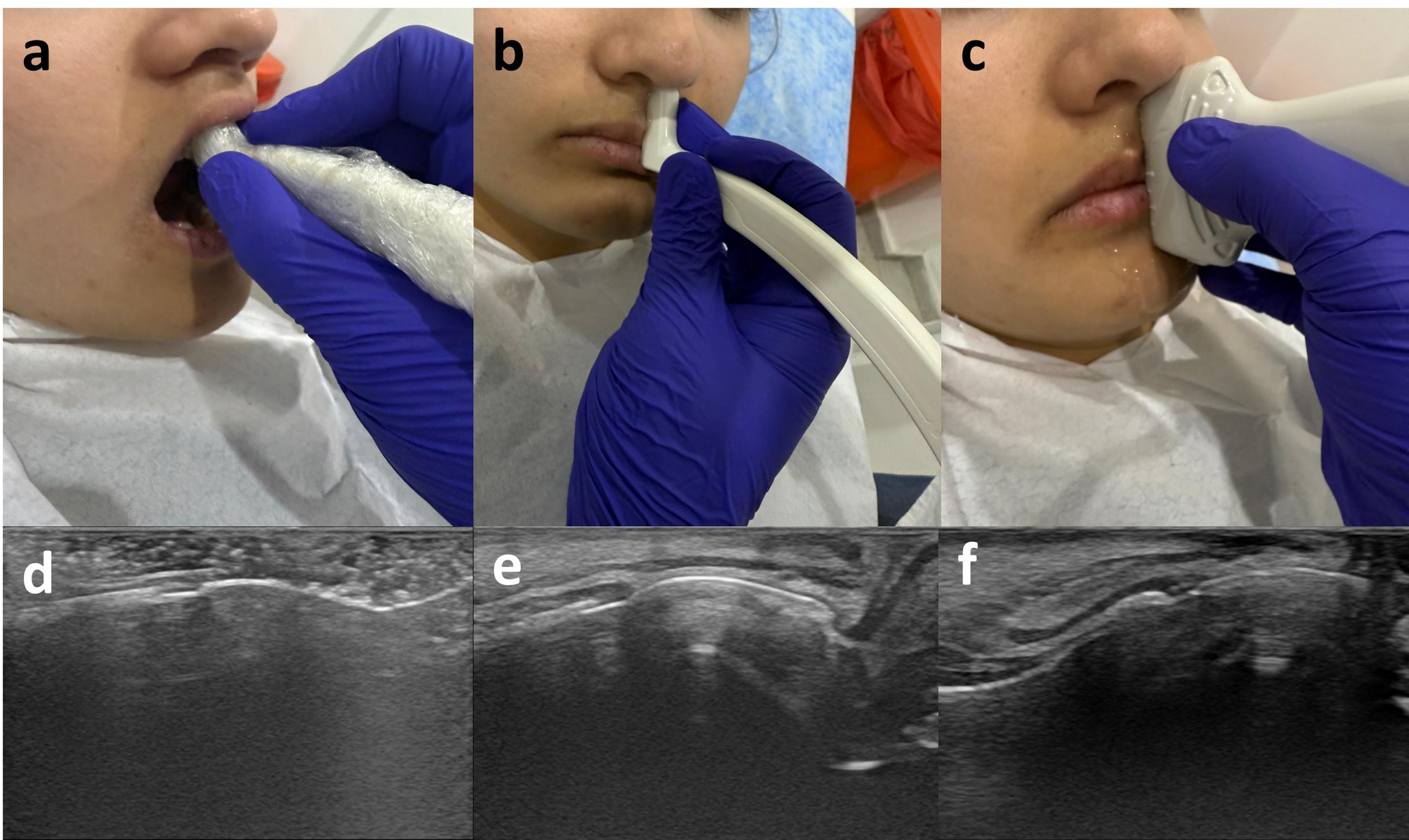 Effect of different ultrasonography probes on intra and interrater reliability in periodontal diagnostic parameter measurements: a pilot study