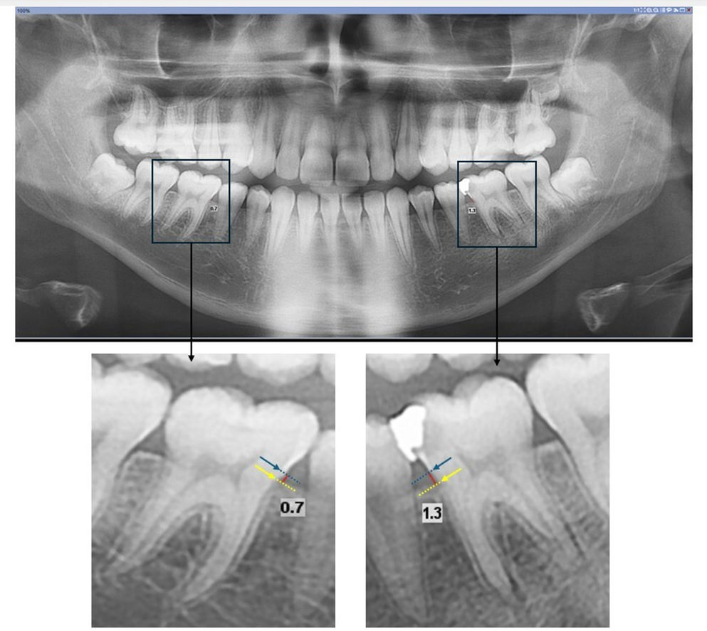 Radiographic assessment of the relationship between alveolar bone loss and overhanging margins of posterior dental restorations in diabetic patients: a retrospective study
