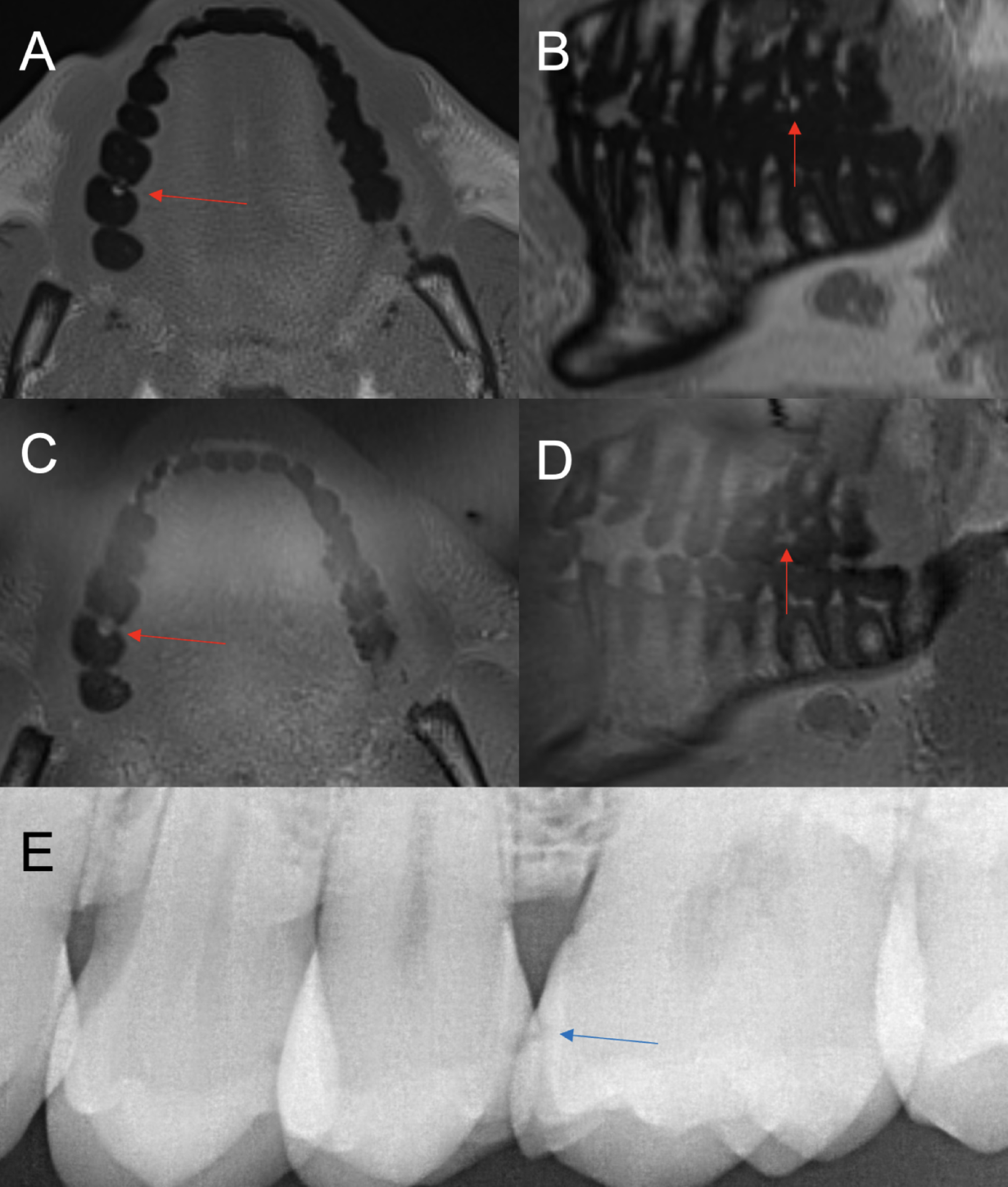 Caries imaging using T1 StarVIBE and PETRA sequences compared to normal dental work-up: a proof-of-concept study