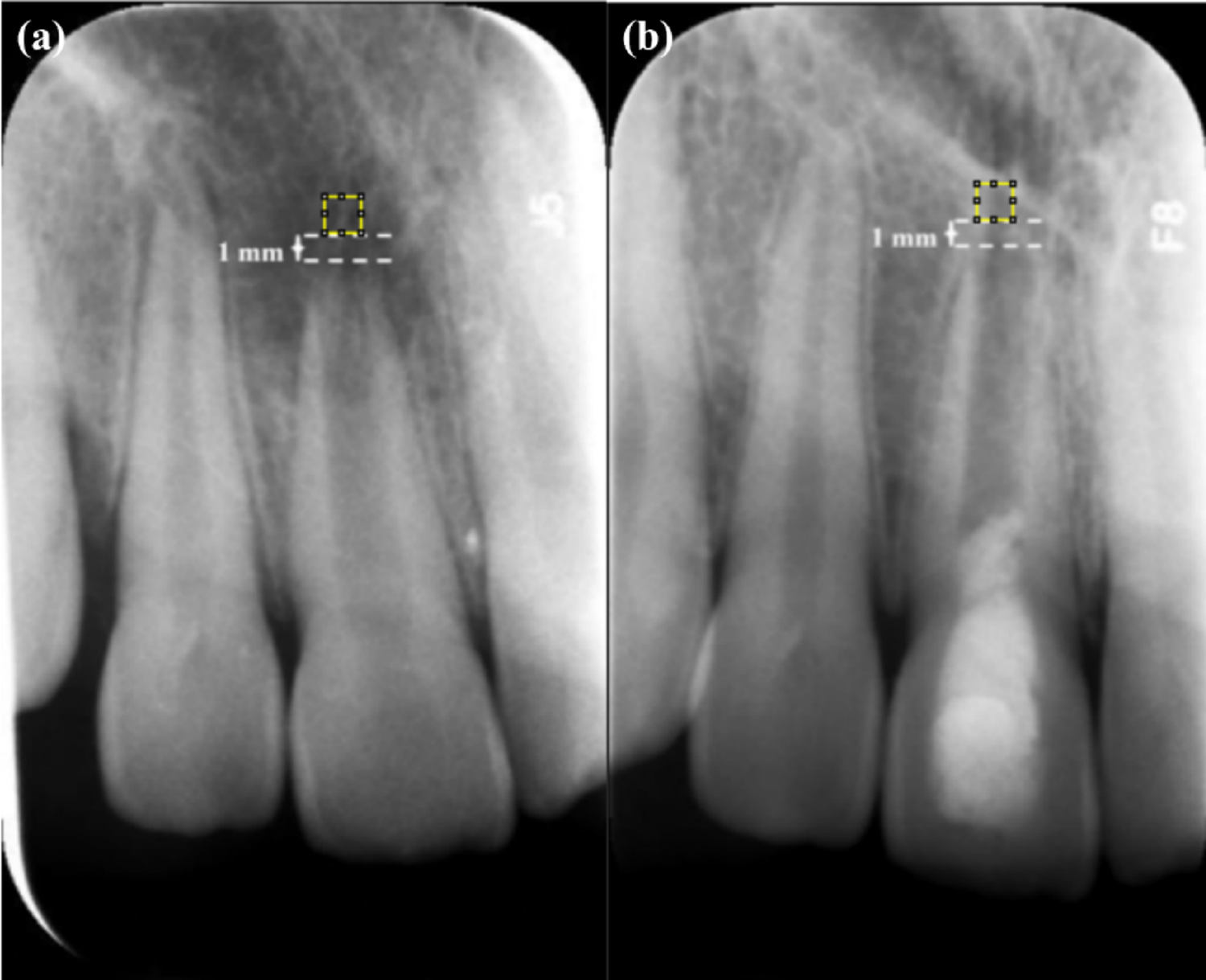 Evaluation of bone healing using fractal analysis in immature permanent teeth with apical periodontitis treated with three different techniques