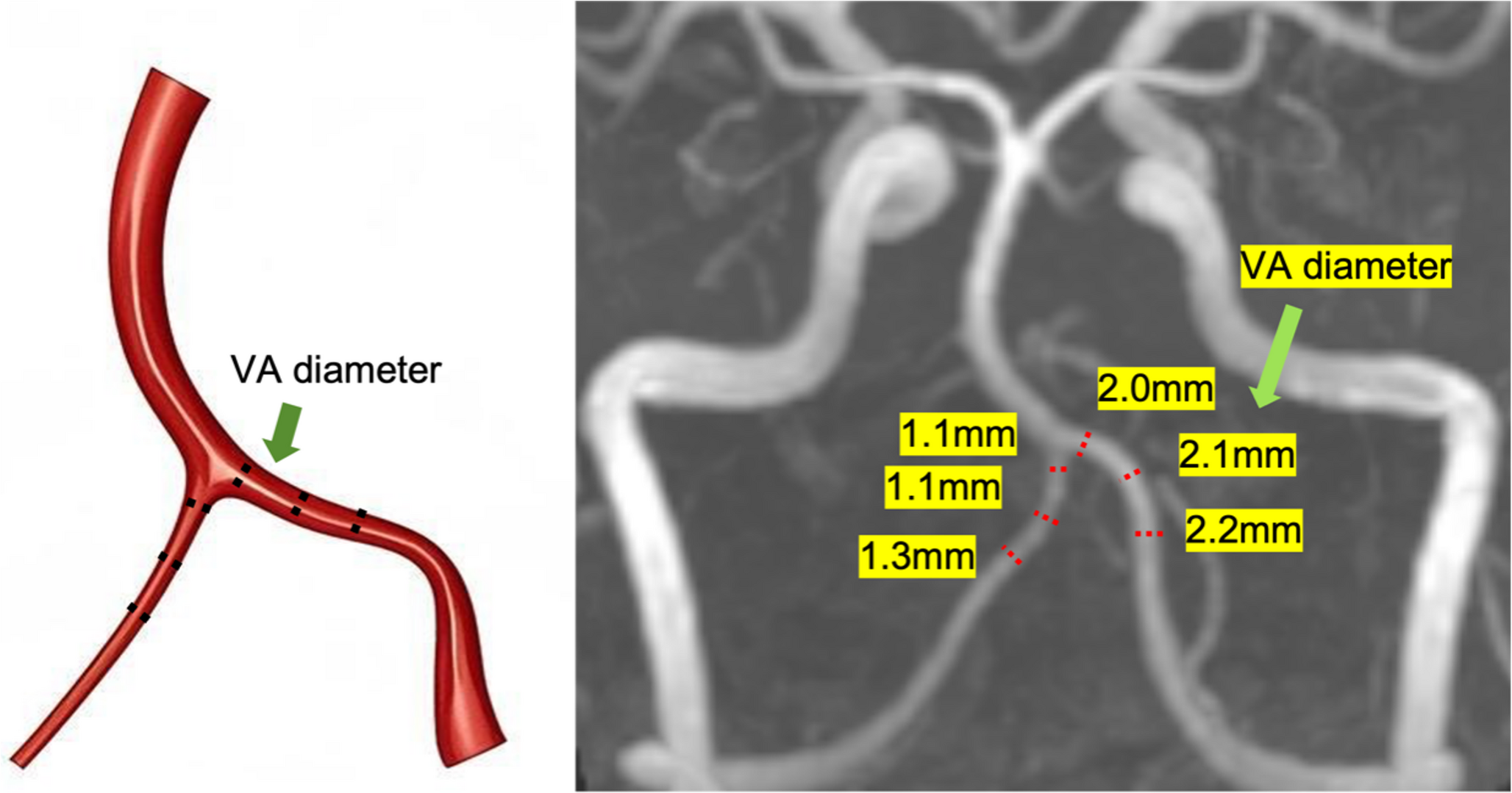 Effect of geometric parameters of the vertebrobasilar artery on vertebrobasilar system geometries and basilar artery curvature