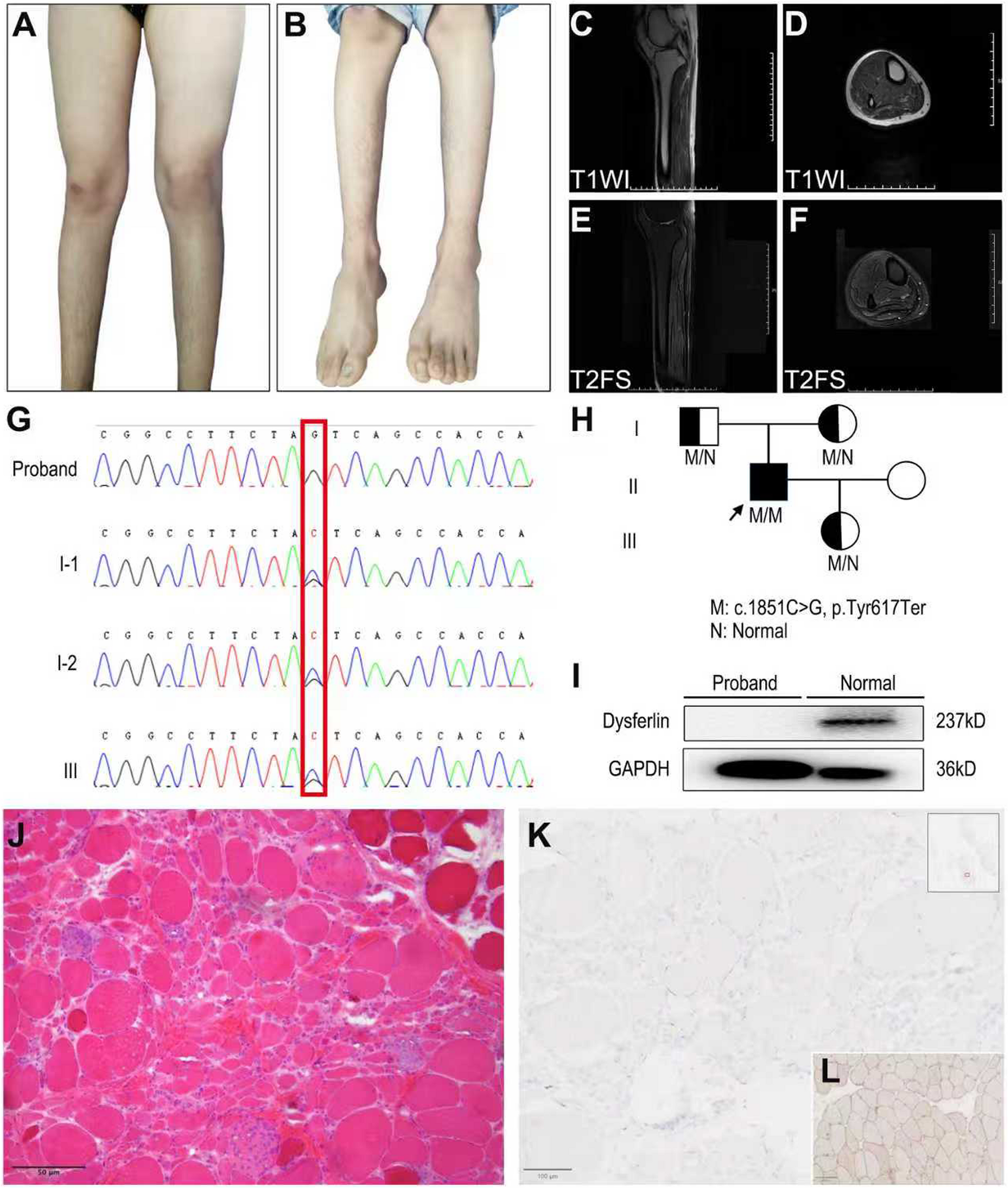 A novel biallelic mutation in the  gene as a cause of Miyoshi myopathy