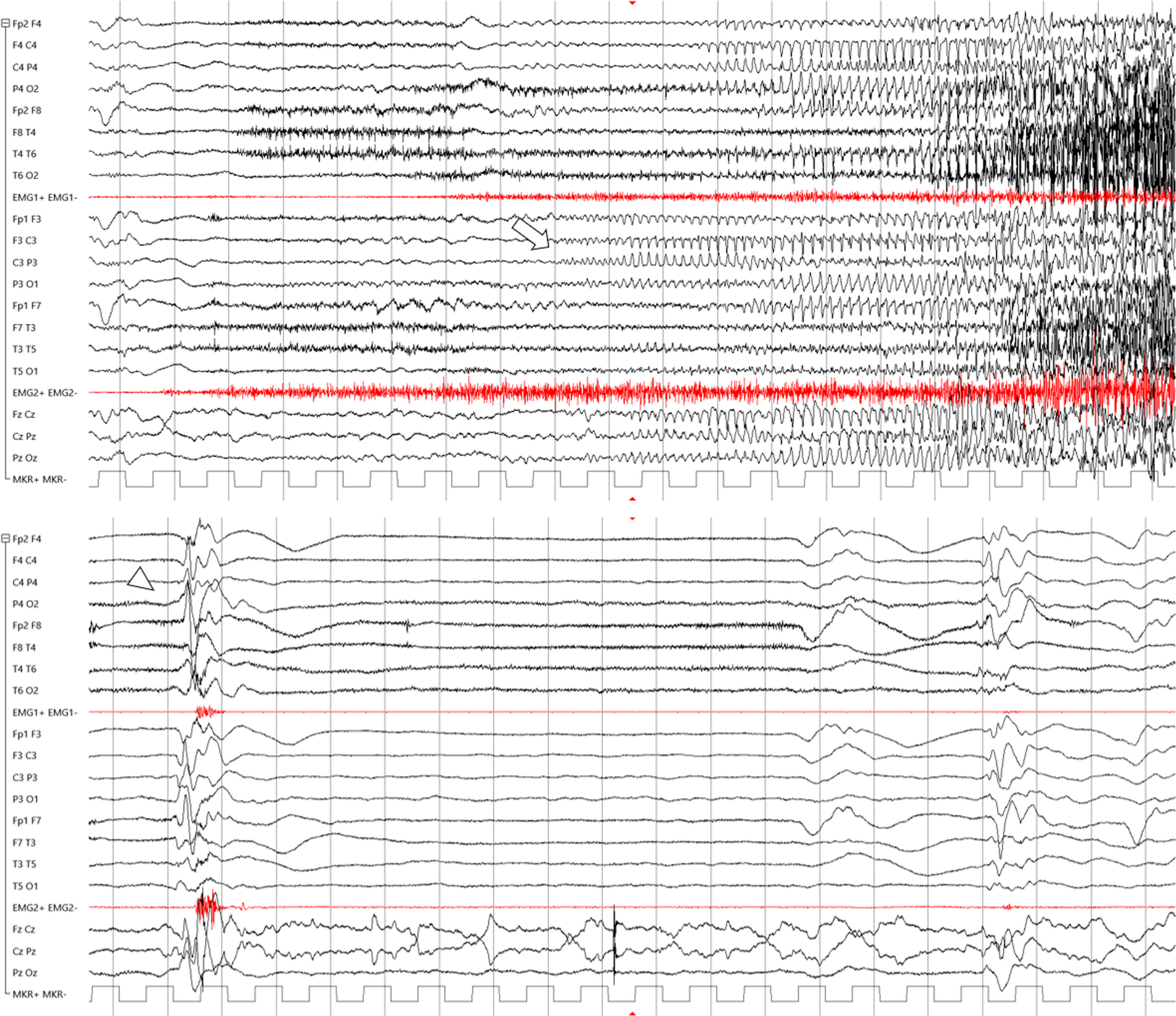 Enlarging the phenotypical spectrum of -related epilepsy