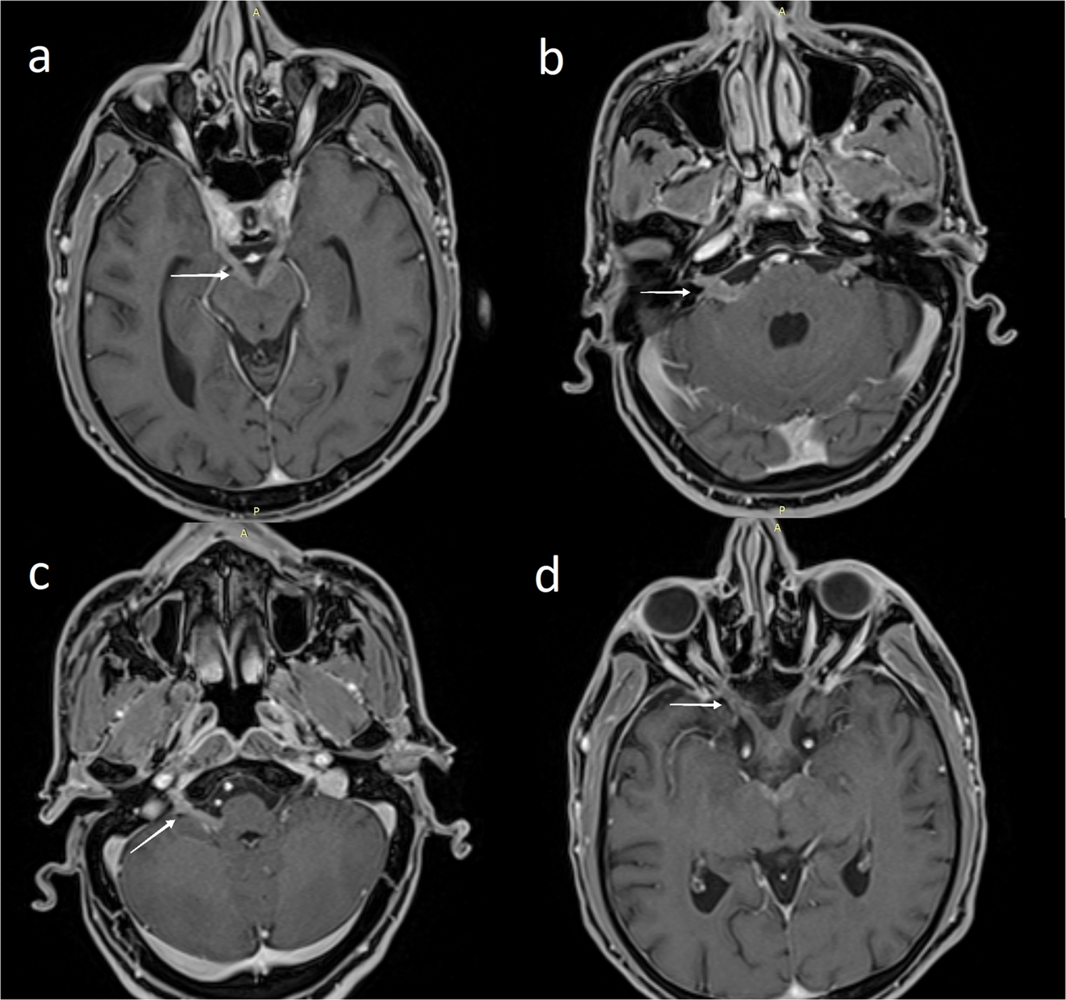 Primary cranial neurolymphomatosis presenting with diffuse cranial nerve and root entry zone involvement
