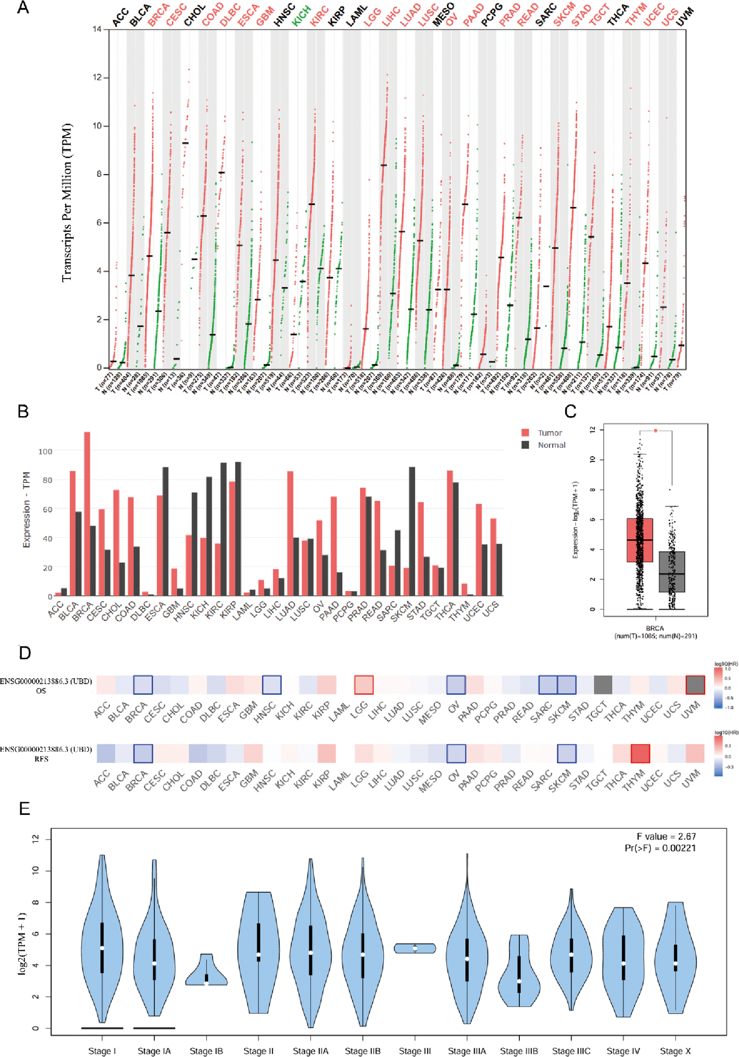 Exploration of the mechanism by which Ubiquitin-like protein UBD promotes malignant progression of breast cancer