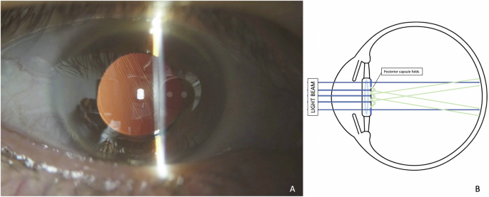 Posterior capsular folds causing monocular diplopia after cataract surgery