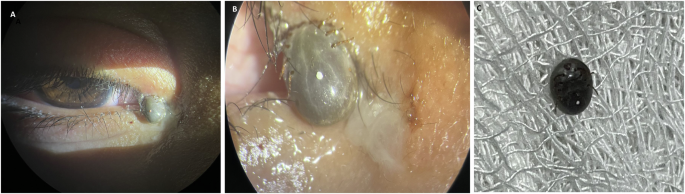 Peri-ocular soft tick infestation in a child
